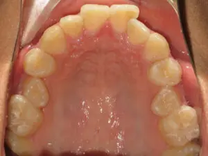 Invisalign Before and After Pictures in Virginia Beach, VA