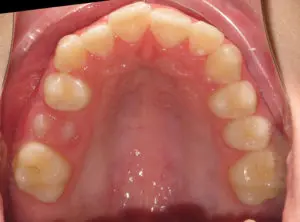 Braces Before and After Pictures Virginia Beach, VA