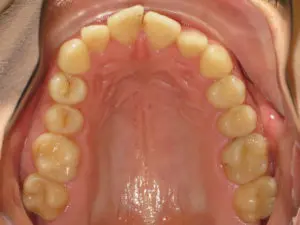 Invisalign Before and After Pictures Virginia Beach, VA