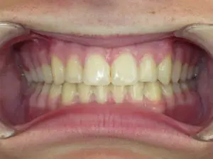 Braces Before and After Pictures Virginia Beach, VA