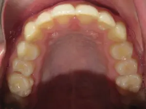 Braces Before and After Pictures Virginia Beach, VA