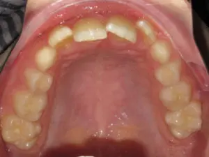 Braces Before and After Pictures Virginia Beach, VA