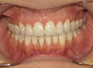 Invisalign Before and After Pictures Virginia Beach, VA