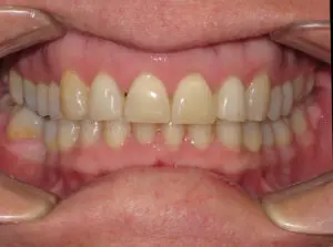 Invisalign Before and After Pictures Virginia Beach, VA