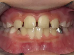 Braces Before and After Pictures Virginia Beach, VA