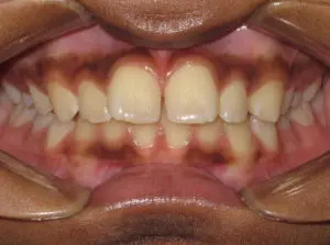 Braces Before and After Pictures Virginia Beach, VA