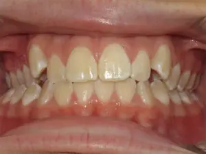 Braces Before and After Pictures Virginia Beach, VA