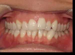 Invisalign Before and After Pictures Virginia Beach, VA