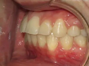 Braces Before and After Pictures Virginia Beach, VA