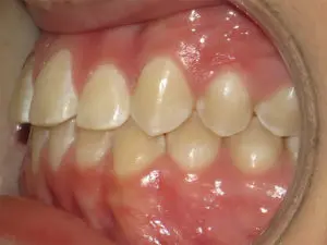 Braces Before and After Pictures Virginia Beach, VA