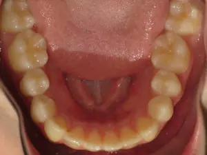 Braces Before and After Pictures Virginia Beach, VA