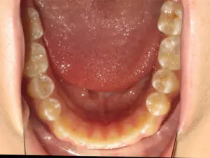 Braces Before and After Pictures Virginia Beach, VA