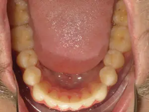 Invisalign Before and After Pictures Virginia Beach, VA