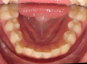 Braces Before and After Pictures Virginia Beach, VA