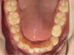 Braces Before and After Pictures Virginia Beach, VA