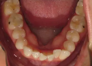 Invisalign Before and After Pictures Virginia Beach, VA