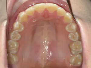 Braces Before and After Pictures Virginia Beach, VA