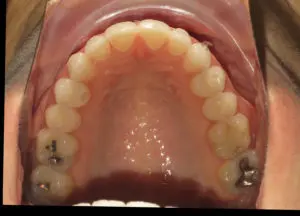 Invisalign Before and After Pictures Virginia Beach, VA