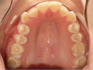 Braces Before and After Pictures Virginia Beach, VA