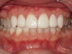 Braces Before and After Pictures in Virginia Beach, VA