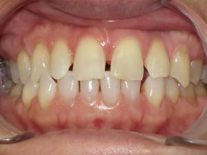 Braces Before and After Pictures in Virginia Beach, VA