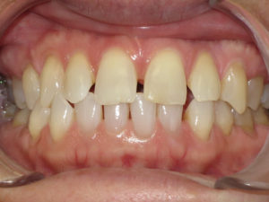 Braces Before and After Pictures Virginia Beach, VA