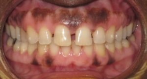 Braces Before and After Pictures Virginia Beach, VA