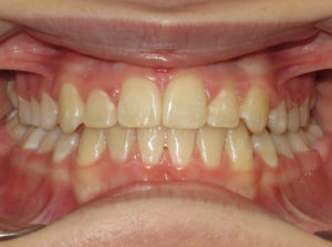 Braces Before and After Pictures Virginia Beach, VA