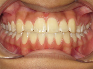 Braces Before and After Pictures Virginia Beach, VA