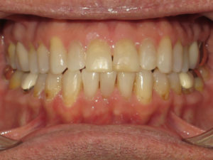 Invisalign Before and After Pictures Virginia Beach, VA