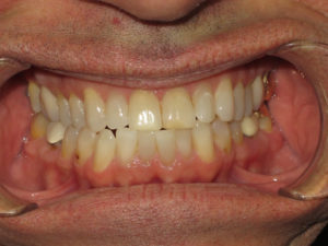 Invisalign Before and After Pictures Virginia Beach, VA