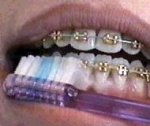 Braces in Virginia Beach, VA