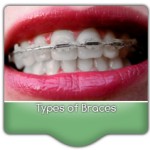 Braces in Virginia Beach, VA