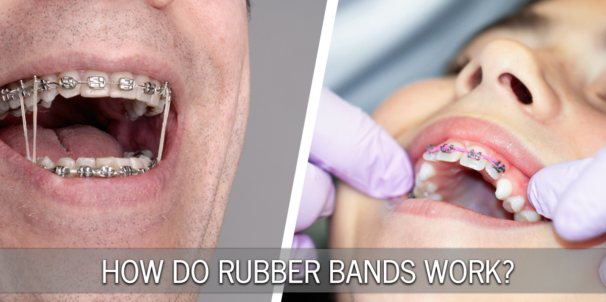 Why Do I Need Rubber Bands With Braces?