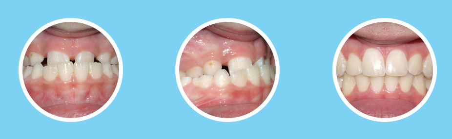 What Causes an Overbite and Underbite?