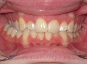 Braces Before and After Pictures Virginia Beach, VA