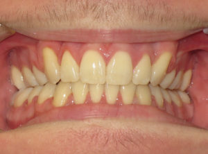 Braces Before and After Pictures Virginia Beach, VA