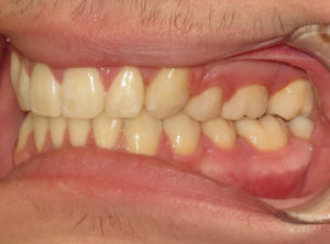 Braces Before and After Pictures Virginia Beach, VA