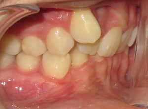 Braces Before and After Pictures Virginia Beach, VA