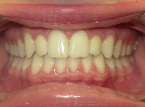 INVISALIGN BEFORE AND AFTER PICTURES IN VIRGINIA BEACH, VA