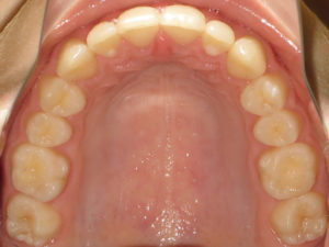 Braces Before and After Pictures in Virginia Beach, VA