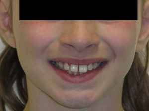 Braces Before and After Pictures in Virginia Beach, VA