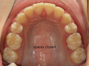 Braces Before and After Pictures in Virginia Beach, VA