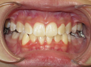 Braces Before and After Pictures in Virginia Beach, VA