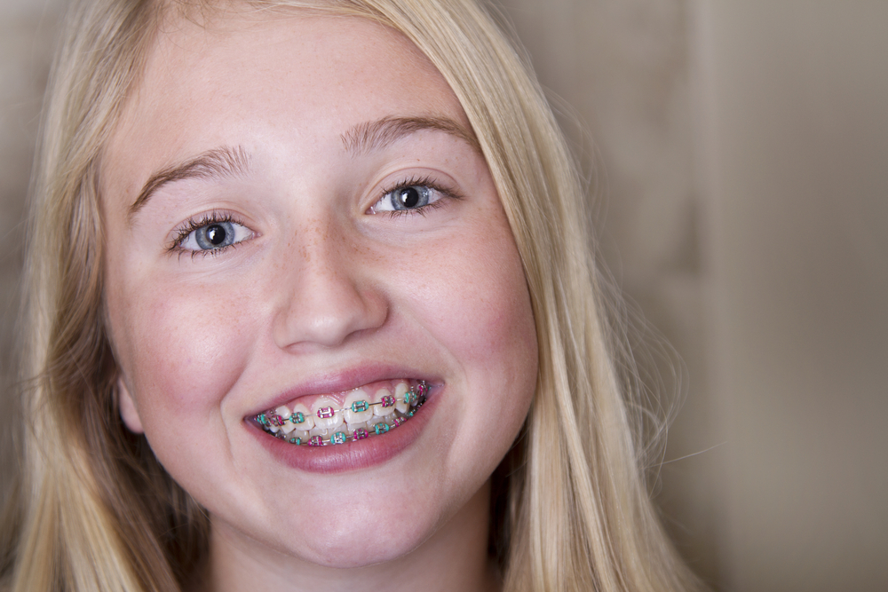 Braces for Kids Virginia Beach, VA Norfolk Braces for Kids