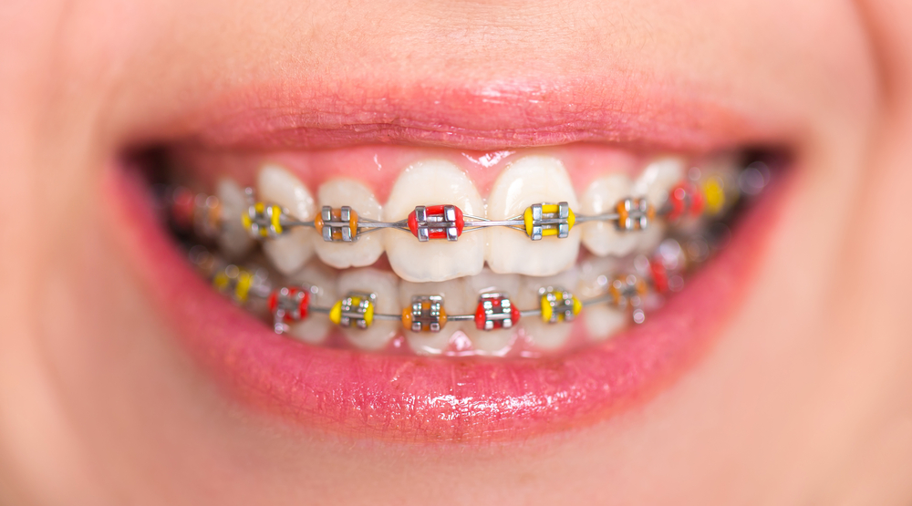 Parts of Braces  Innovative Orthodontic Centers