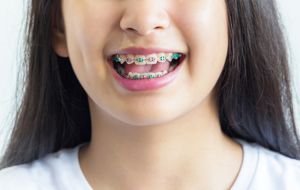 First time braces