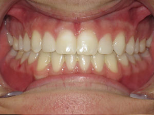 Braces Before and After Pictures Virginia Beach, VA