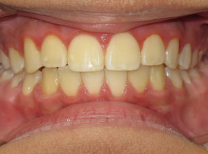 Invisalign Before and After Pictures in Virginia Beach, VA