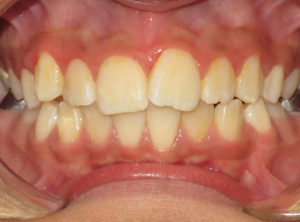 Invisalign Before and After Pictures in Virginia Beach, VA